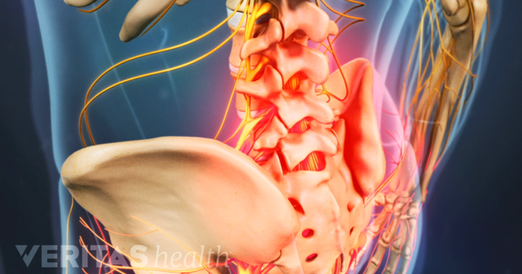 Can spinal stenosis cause hip pain the comella foundation